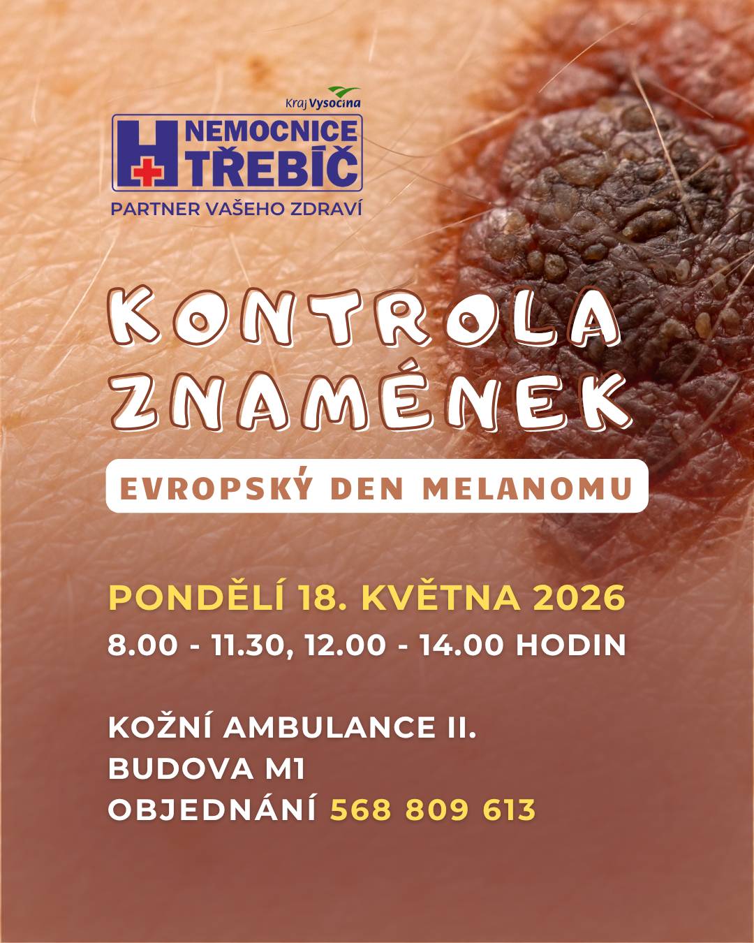 Vážení pacienti, kožní oddělení Nemocnice Třebíč Vás zve v rámci EVROPSKÉHO DNE MELANOMU na preventivní kontrolu znamének, která se bude konat v pondělí 18. května 2026 od 8.00 do 11.30, od 12.00 do 14.00 hodin (budova M1, kožní ambulance II.). Včasná kontrola může sehrát důležitou roli. Pokud máte znaménko, které se mění, neváhejte se objednat.